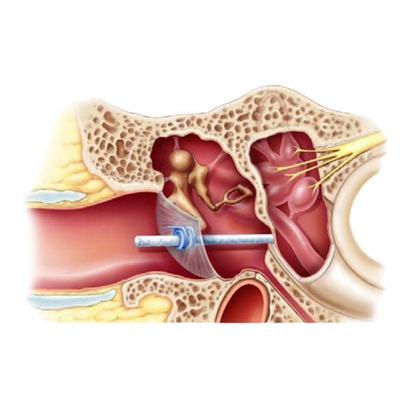 MicroWick Drug Delivery System Wick 9x1mm