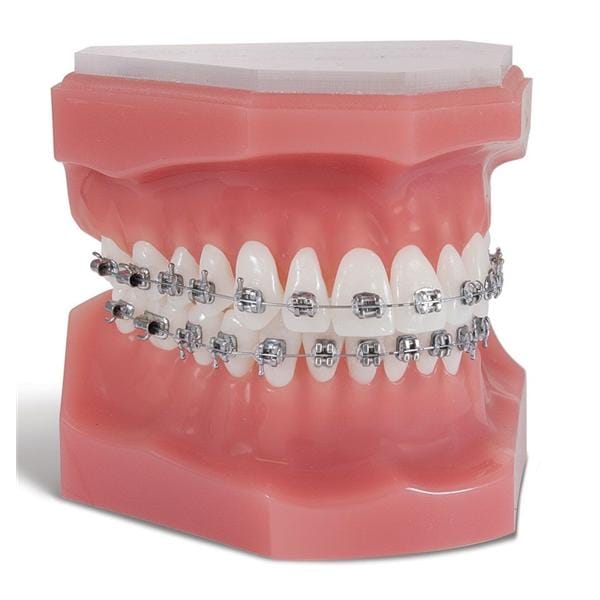 Pinnacle Bracket .018 in Upper Left 10/Pk product image