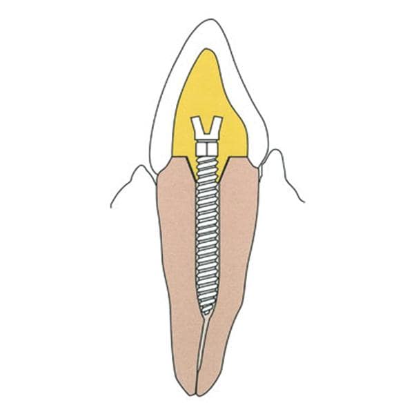Surtex Posts SS Refill Sz 1.35 mm Parallel Sided & Tapered End 12/Bx