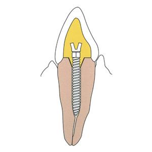 Surtex Posts Stainless Steel Size 1.5 mm Parallel Sided & Tapered End 12/Bx