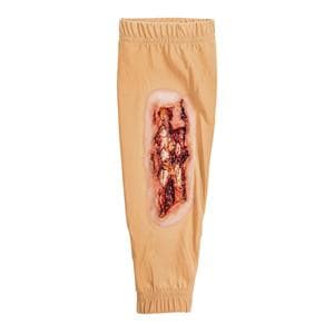 STOPS Medical Radial/Ulna Fracture Leg Sleeve Ea