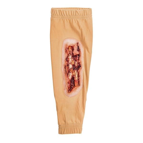 STOPS Medical Radial/Ulna Fracture Leg Sleeve Ea