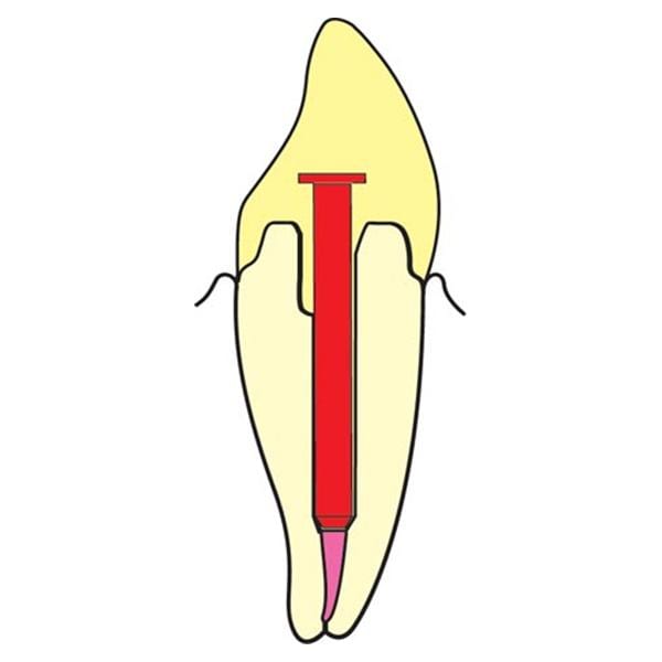 ParaPost XP Temporary Posts Titanium 5 0.05 in Red 20/Pk