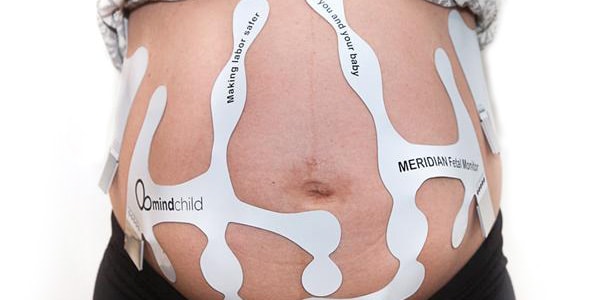 MERIDIAN M110 Disposable Electrode Patch - Henry Schein Medical