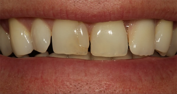 unretracted smile view