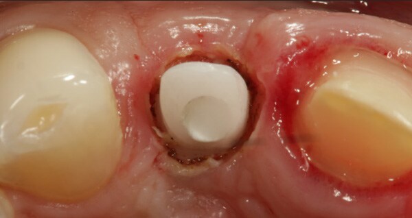 custom implant abutment showing the exposed margins