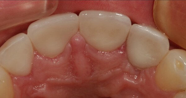 incisal view after prosthetic correction of tooth