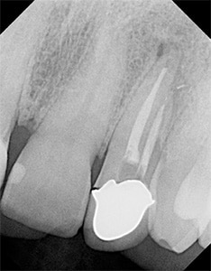 Preoperative periapical radiograph of tooth #10