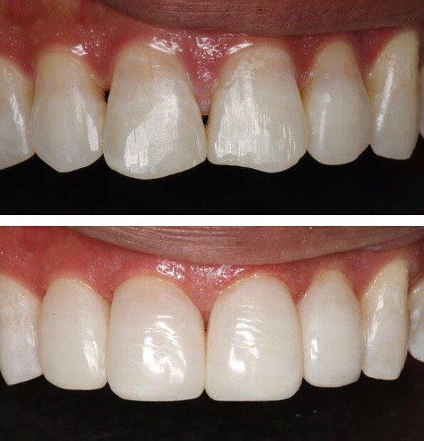 Direct Composite Veneers vs. Porcelain Veneers División odontológica