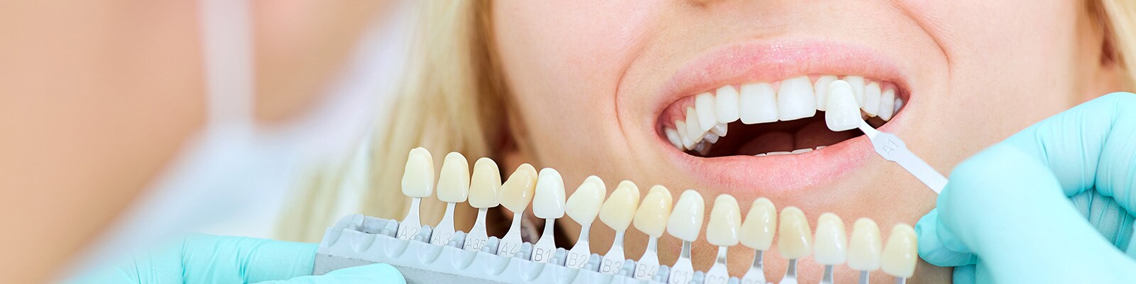 Tooth Whitening Treatments